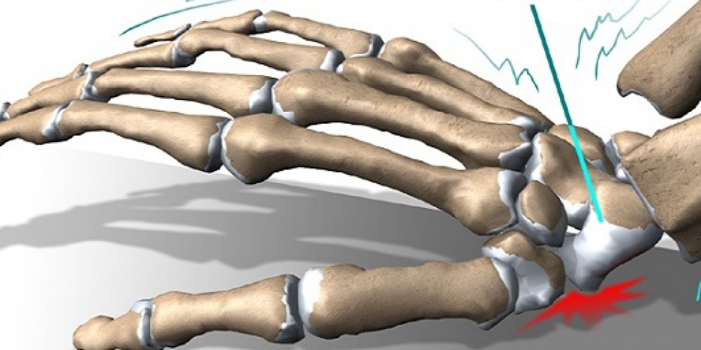 Перелом лучевой кости в типичном месте: как разработать руку